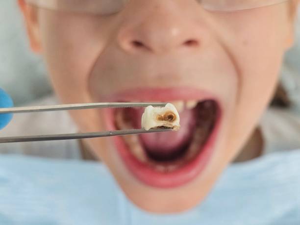 Best Emergency Root Canal Treatment in Four Bridges, OH